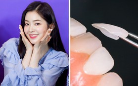 Irene (Red Velvet) cũng "sứ hóa" hàm răng nhưng không cần dùng cách phải mài răng bé xíu mà vẫn đẹp