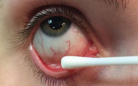 Chàng trai 20 tuổi mắc bệnh lây truyền qua đường tình dục nhưng triệu chứng lại xuất hiện ở... mắt