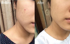 4 lọ serum đỉnh cao giá dưới 300k giúp bạn tạm biệt tình trạng "thu đi để lại lá vàng, mụn đi để lại muôn vàn vết thâm"