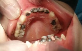 Vì suy nghĩ sai lầm của cha mẹ mà bé gái mới 5 tuổi đã có 14 chiếc răng sâu trong miệng