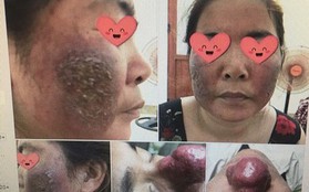 Mặt "nát" tanh bành chỉ vì ham hố trị nám bằng laser tại spa: Chuyên gia đưa ra cảnh báo ai cũng phải dè chừng