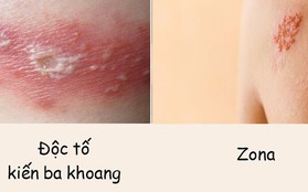 Phân biệt vết thương do kiến ba khoang với viêm da do zona để tránh dùng sai thuốc khiến bệnh càng khó chữa