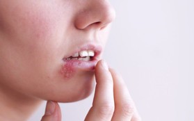 Những nhầm tưởng về mụn rộp sinh dục herpes mà không ít phụ nữ mắc phải