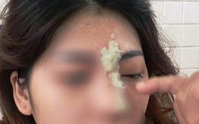 Cô gái 21 tuổi mù mắt sau khi tiêm filler nâng mũi
