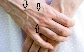 Người có chức năng gan ổn định sẽ không có 4 điểm lạ trên đôi tay, cùng xem bạn có điểm nào hay không
