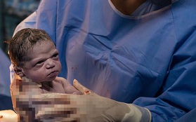 "Vui vẻ, hông quạu": Biểu cảm nhăn nhó siêu hài hước của bé sơ sinh khi đang được các bác sĩ chuẩn bị cắt rốn gây sốt MXH