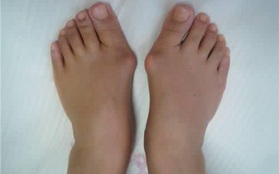 Phụ nữ có nhiều nguy cơ bị vẹo ngón chân cái hơn nam giới và đây là phương pháp cải thiện