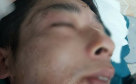Hà Tĩnh: Người đàn ông bị trâu húc rách mặt khi vào rừng