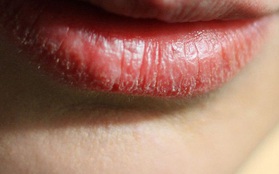 Bong tróc môi có thể là dấu hiệu cảnh báo những vấn đề sức khỏe nghiêm trọng hơn bạn tưởng