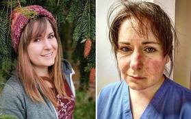 Nữ y tá xinh đẹp chia sẻ hình ảnh gương mặt biến dạng, đã đi qua "địa ngục" sau 65 tiếng làm việc và lời khẩn cầu dành cho tất cả mọi người