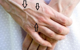 5 đặc điểm lạ xuất hiện trên bàn tay có thể là tín hiệu cảnh báo nguy cơ mắc bệnh xơ gan