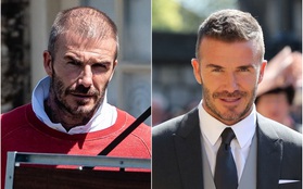 Beckham và những ngôi sao bóng đá tút lại vẻ đẹp trai nhờ phương pháp cấy tóc