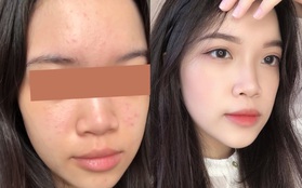 Từng bị mụn ẩn sần mặt, cô bạn giờ có làn da láng mịn phát hờn nhờ quy trình skincare kết hợp thông minh đồ bình dân và đắt tiền