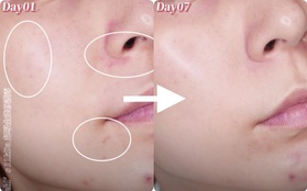 Beauty blogger xứ Đài trực tiếp "check" khả năng trị nám, trẻ hóa da của serum Kiehl's: Sau 7 ngày vết thâm to mờ dần, vết nhỏ lặn mất tăm