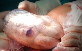 Ca sinh 3 tự nhiên hiếm gặp ở Bệnh viện Từ Dũ