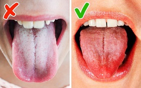 Lưỡi có thể tiết lộ tình trạng sức khỏe của bạn đang gặp vấn đề gì: quan sát 3 đặc điểm sau ở lưỡi là sẽ thấy rõ