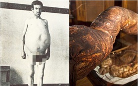 Chuyện kỳ lạ về người đàn ông bị táo bón bẩm sinh, chết khi cố đi đại tiện và ruột già được trưng bày trong bảo tàng Mỹ gây "sởn da gà"