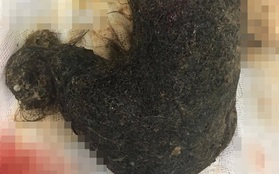 Bé gái 11 tuổi ở Hà Nội có khối u khổng lồ trong cơ thể chứa toàn tóc, nguyên nhân do 1 thói quen từ năm 2 tuổi của bé