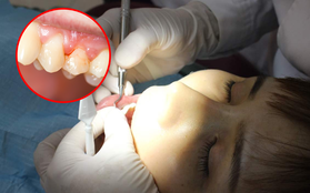 Thường xuyên bị chảy máu khi đánh răng, cô gái 26 tuổi bị viêm nha chu nặng, phải "vĩnh biệt" cùng lúc 11 chiếc răng