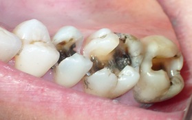 6 dấu hiệu điển hình cảnh báo nguy cơ lão hóa răng sớm mà nhiều người chẳng ngờ đến