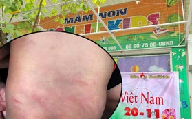 Đến đón con tan học, bà mẹ Quảng Ninh bức xúc khi thấy con bị cô mẫu giáo buộc vào ghế đánh, lưng và mông chằng chịt vết lằn đỏ