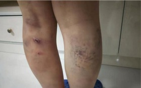 Nữ sinh bị 5 giáo viên đánh bầm tím tay chân vì giúp bạn mang sữa cho crush