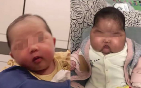 Bé trai 5 tháng tuổi bỗng dưng bị "to đầu" sau khi sử dụng kem kháng khuẩn sản xuất tại Trung Quốc?