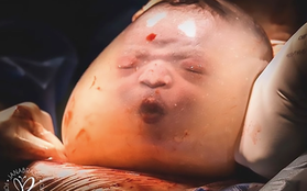 Bé trai trong bức ảnh “sinh ra vẫn đang nằm nguyên trong túi ối” từng gây chấn động thế giới vài năm trước giờ ra sao?
