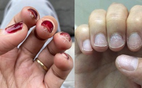 Trước Tết thi nhau khoe nail sang chảnh, ra Tết lại kể "khổ" vì móng nham nhở như chuột gặm: Ai làm nail cũng chịu trận cảnh này thôi!