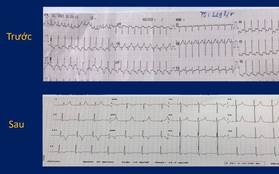 Cứu sống bệnh nhi 9 tuổi nhịp tim nhanh kịch phát 229 lần/phút