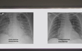 So sánh ảnh chụp phổi của bệnh nhân COVID-19 đã tiêm và chưa tiêm vaccine, phát hiện điều kinh ngạc
