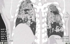 F0 không có triệu chứng, phổi vẫn trắng xoá hậu Covid-19