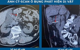 Cụ ông suýt chết vì bị xương cá xuyên thủng dạ dày