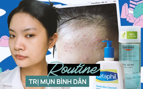 Bị mụn dai dẳng suốt 1 năm, mình đã tìm ra chu trình dưỡng da, trị mụn với các sản phẩm bình dân chỉ từ 92k