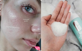 Dành cho nàng da dầu: Bác sĩ da liễu chỉ rõ bước skincare cân mọi loại dầu nhờn trong mùa Hè