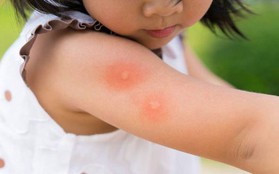Trẻ bị sốt xuất huyết: Áp dụng một trong 4 cách sau sẽ nhanh khỏi bệnh tại nhà