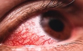 Châu Âu ghi nhận virus gây xuất huyết ở mắt, tỷ lệ tử vong đến 30%