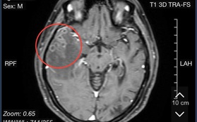 Lại thêm một ca sán làm tổ trong não bệnh nhân
