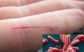 Sau ca tử vong do nhiễm vi khuẩn "ăn thịt người", Sở Y tế Quảng Nam chỉ đạo nóng