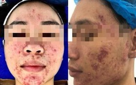 Dùng mỹ phẩm không rõ nguồn gốc, nhiều bạn trẻ bị "nát mặt"