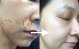 Dùng thử dầu dưỡng da giá 150k mà beauty blogger Trinh Phạm gợi ý: Lên da mịn mướt, vết thâm mờ hẳn sau vài ngày