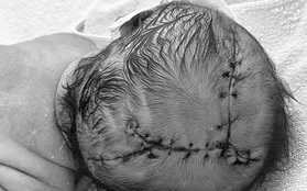 Khâu 21 mũi cho trẻ sơ sinh bị lóc da đầu sau khi sinh tại nhà
