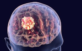 Từ đau đầu đến ung thư di căn não: Cần biết về triệu chứng và phương pháp điều trị