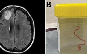 Ca mổ lấy giun sống khỏi não người đầu tiên trên thế giới