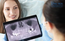 Công nghệ trồng răng implant vượt trội tại Nha khoa Quốc tế Phú Hòa