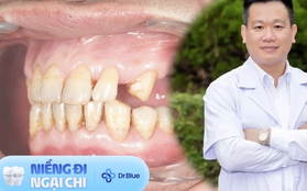 Mới 40 tuổi đã phải ăn đồ mềm như em bé do hệ luỵ của 1 thói quen tưởng chừng không làm mất răng