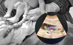 Sản phụ 20 tuổi chuyển dạ, bác sĩ siêu âm giật mình trước hình ảnh bất thường của dây rốn: Mổ lấy thai khẩn cấp!