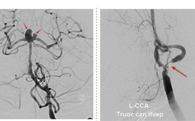 Người phụ nữ bị cùng lúc 2 dạng đột quỵ đặc biệt nguy hiểm