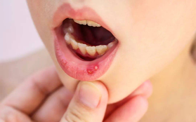 4 dấu hiệu răng miệng cảnh báo ung thư đang đến gần
