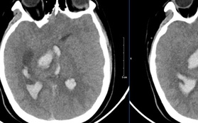 Nam sinh 15 tuổi tử vong vì đột quỵ